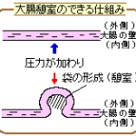 憩室炎